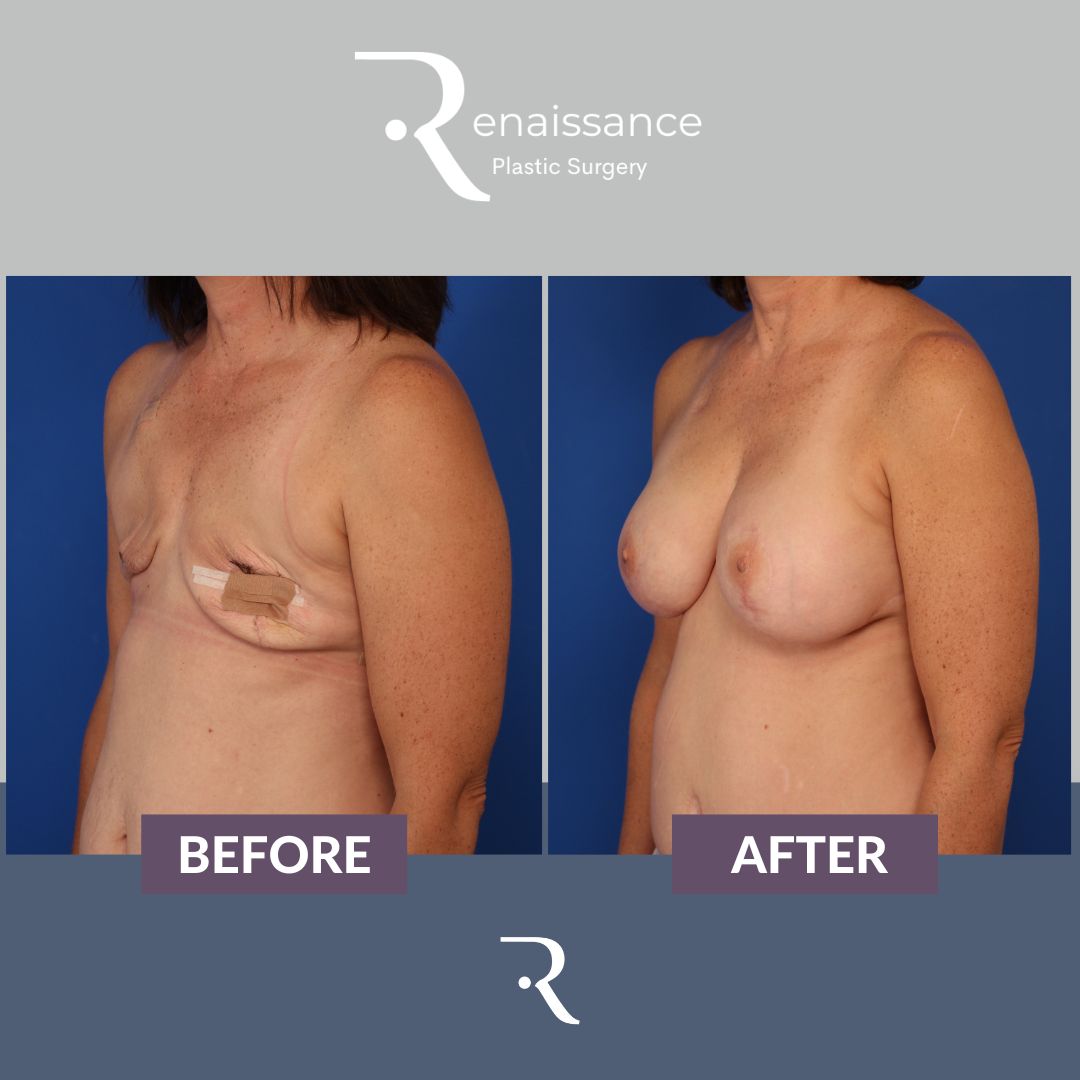 Breast Reconstruction DIEP - Before and After - 2 Side