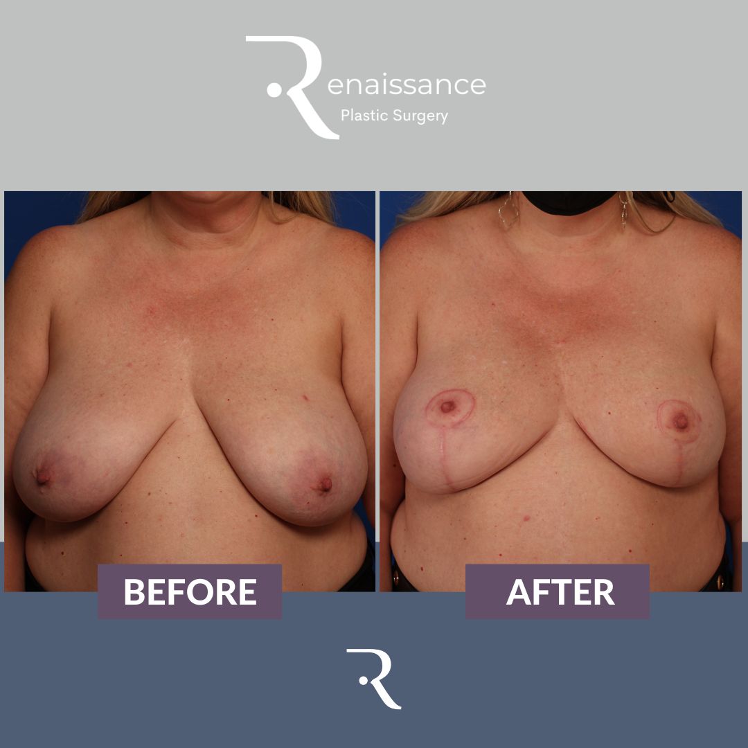 Breast Reconstruction DIEP - Before and After - 3 Front