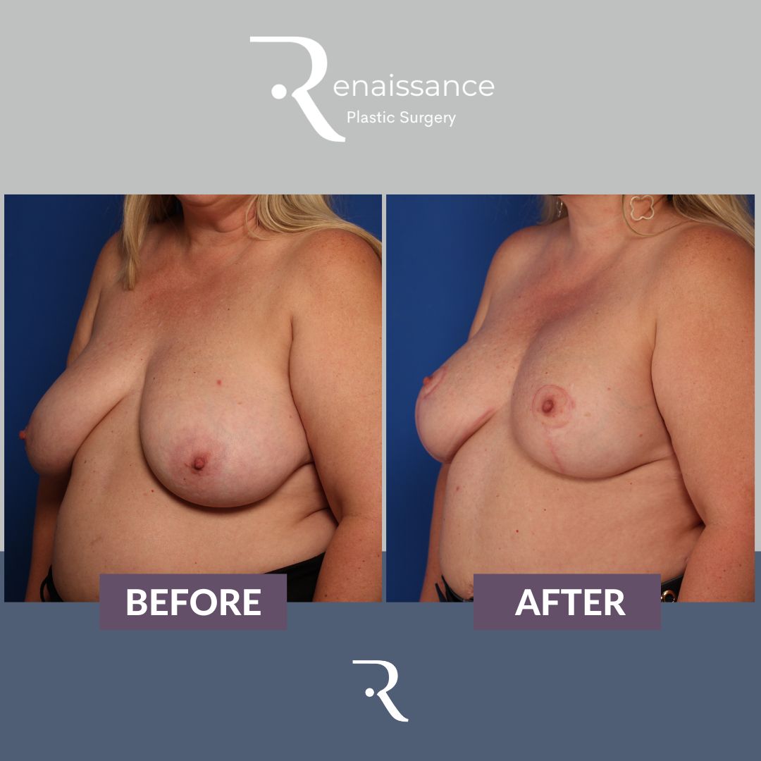 Breast Reconstruction DIEP - Before and After - 3 Side