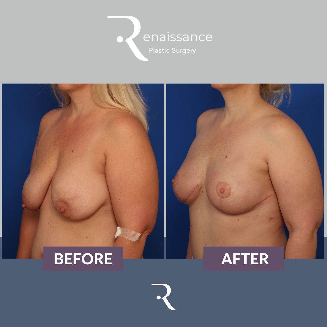 Breast Reconstruction DIEP - Before and After - 4 Side