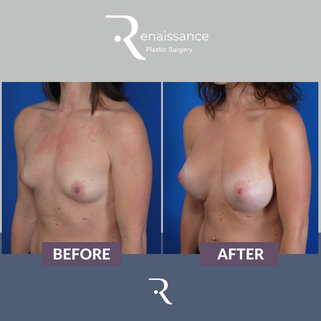 Breast Augmentation Before and After 17 - Side