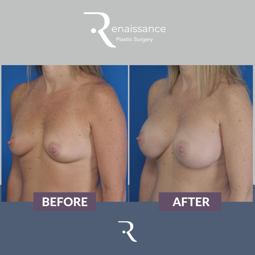 Breast Augmentation Before and After 7 - Side