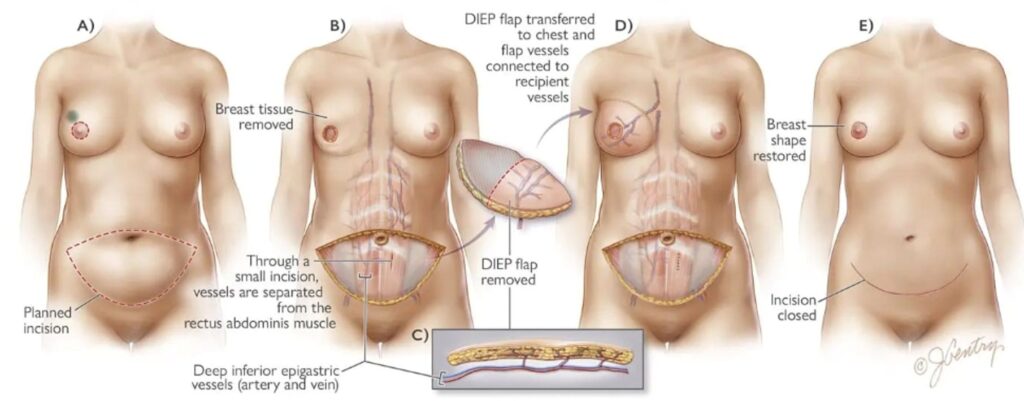 DIEP Surgery Illustration